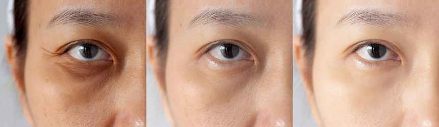 how to avoid under eye darkness at home